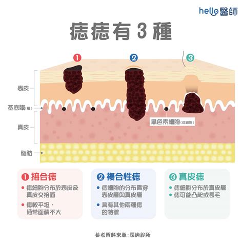 長痣原因|痣是什麼？一次了解痣原因、就醫時機以及如何改善